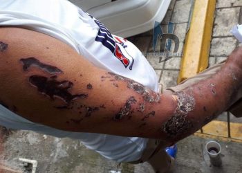 De esta manera quedó el chófer que conducía el vehículo de la joven agredida con ácido del diablo 