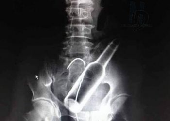 llegó al hospital con una botella de cerveza Corona en el ano