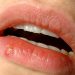 Cómo evitar y tratar la infección del herpes labial