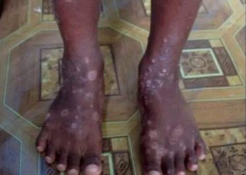 ALERTA R.D. Haití reporta enfermedad «altamente contagiosa» por contacto con la piel