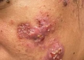 ALERTA – Haití reporta enfermedad «altamente contagiosa» por contacto con la piel