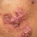 ALERTA – Haití reporta enfermedad «altamente contagiosa» por contacto con la piel