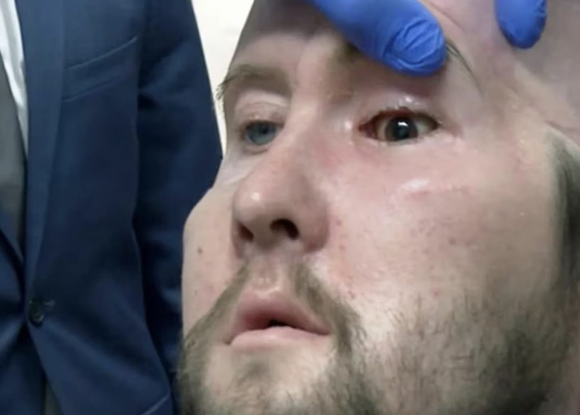 En el mundo, realizan con éxito primer transplante de ojo completo